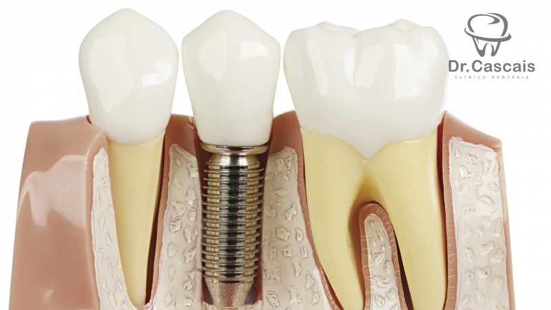 Foto: Implantologia e Cirurgia Oral 